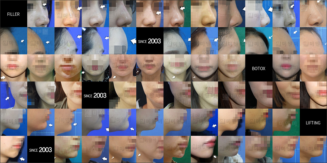 SINCE 2003 MI&MI, 시술후사진모음 미앤미 비만클리닉,HPL,비만주사,지방분해주사,카복시,비만관리,비만약처방