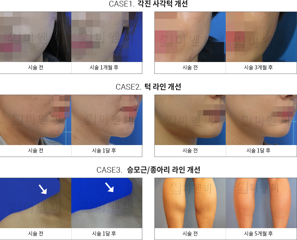 시술전후사진 승모근 보톡스 : 각진 사각턱 개선,턱 라인 개선,승모근/종아리 라인 개선 미앤미, 레이저토닝, 사각턱보톡스, 인모드, 올리지오, 포텐자, 클라리티, 피코토닝